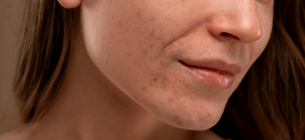 A gyulladt pattanás kezelése