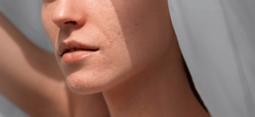 A pattanások eltüntetése